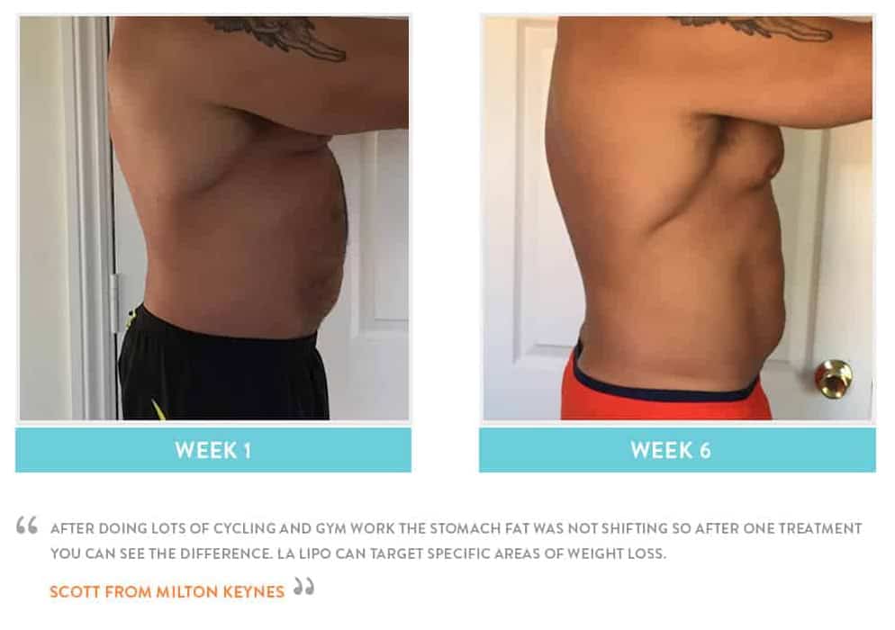 Before & After Stomach Fat Worksop
