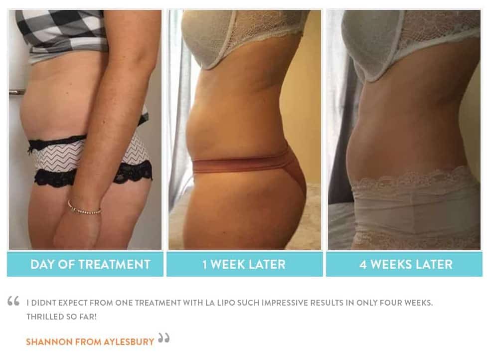 before, Cryolipolysis Worksop