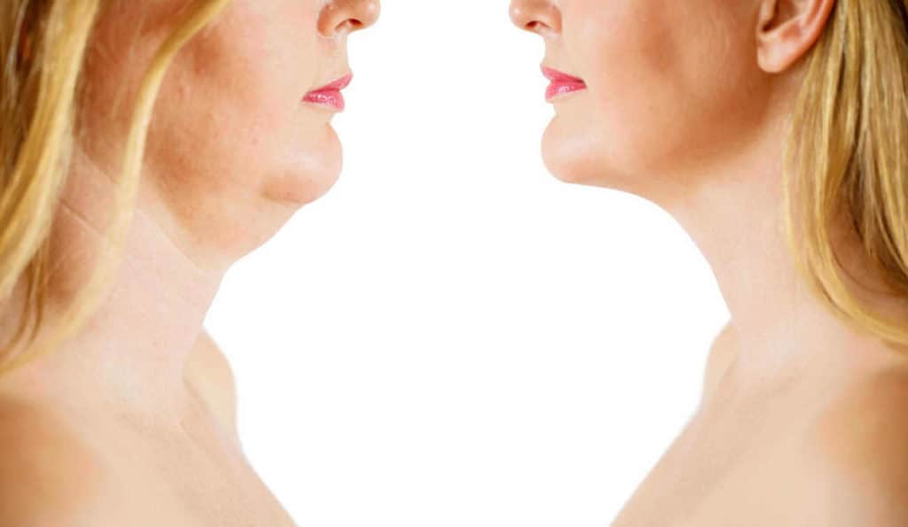 Double Chin treatment Worksop before and after results