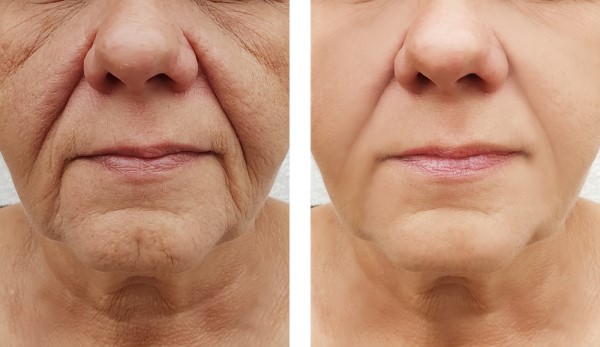 Learn more about Morpheus8 Treatment Worksop today!