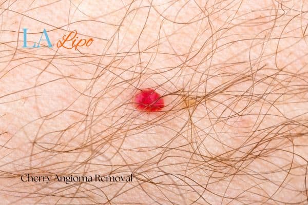 Cherry Angioma Removal