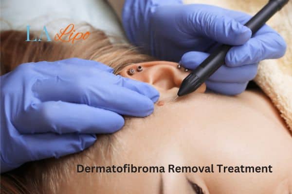 Dermatofibroma Removal Treatment Worksop