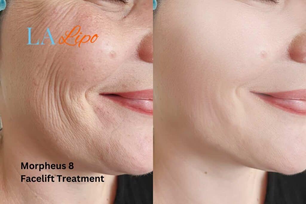 Morpheus8 Treatment Worksop for flawless skin! Call us today!