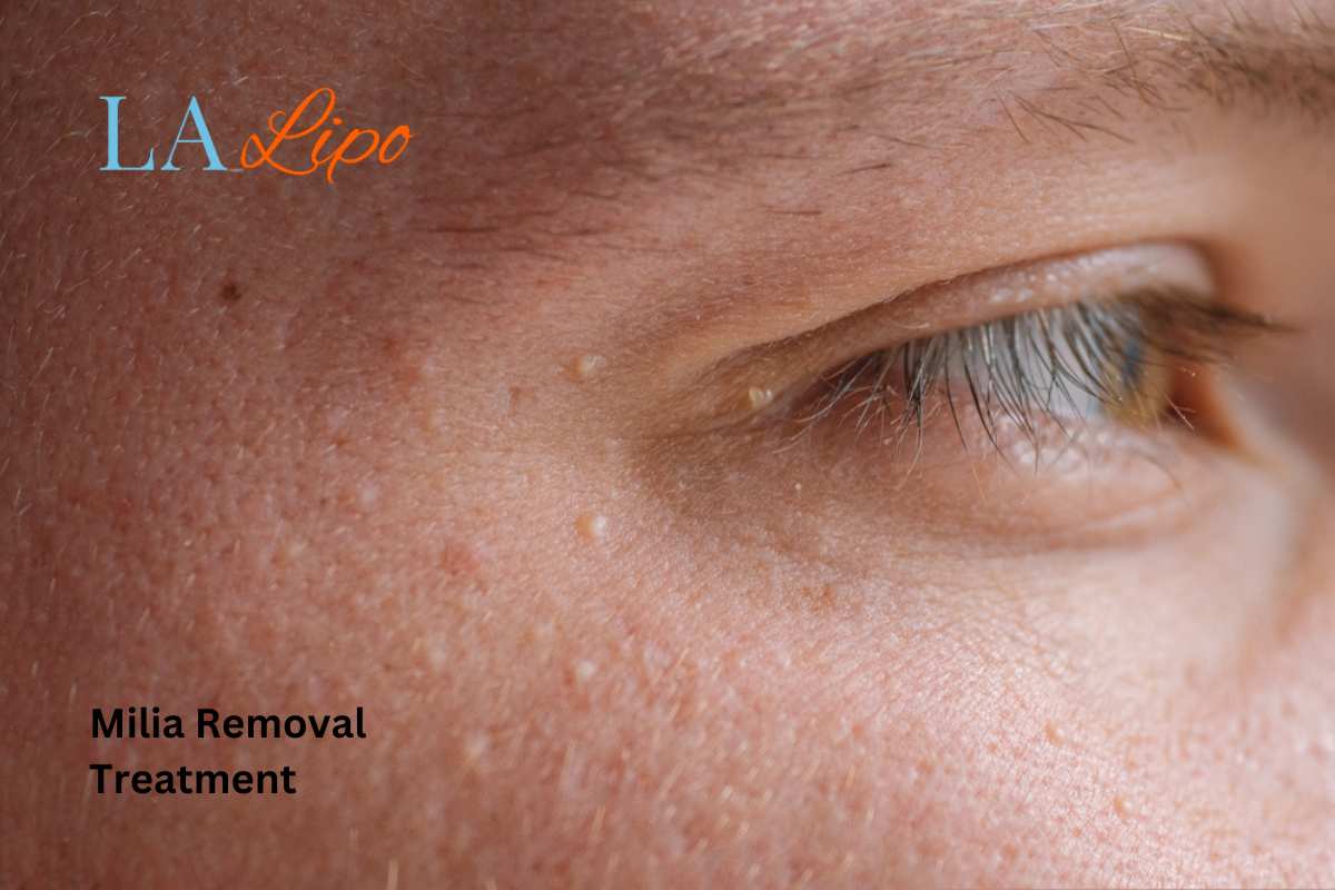 Cryopen Milia Removal: Is It the Easiest and Safest Option Worksop?