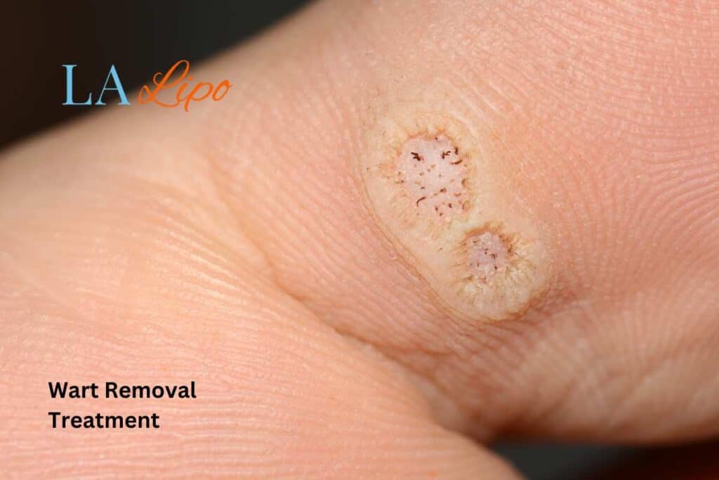wart removal