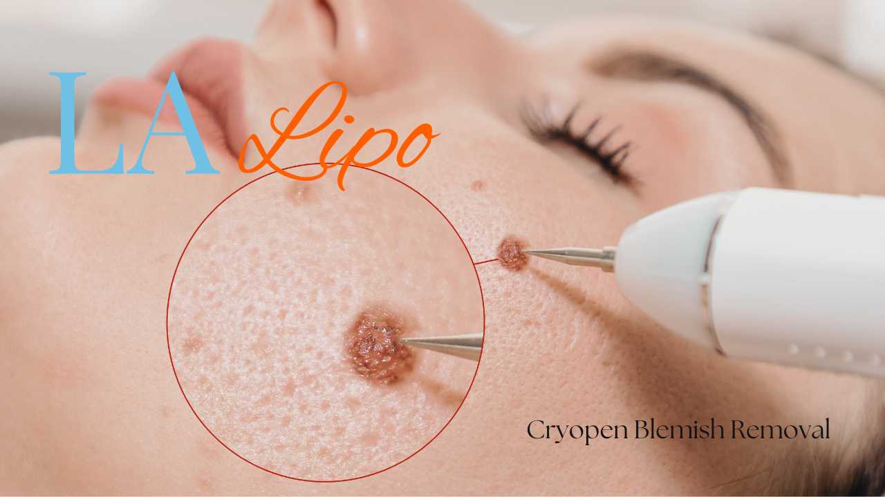 cryopen blemish removal Worksop Contact our team today!