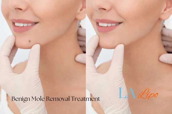 Before-and-after results following benign mole-removal treatment Worksop