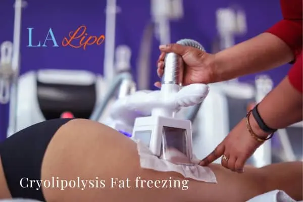 women getting fat freezing Worksop
