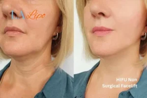 hi-fu for wrinkles Worksop before and after results