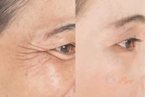Before and after results of woman - HI-fu wrinkles reduction treatment Worksop