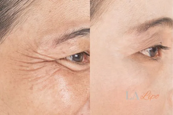 Before and after results of woman - HI-fu wrinkles reduction treatment Worksop