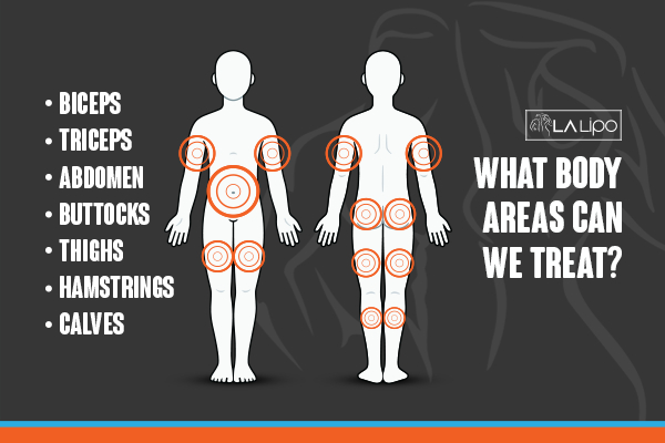 Graphic to show areas you can have LA-EMS Body Sculpting Worksop treatment.
