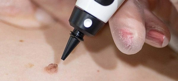skin tag removal using cryopen Worksop