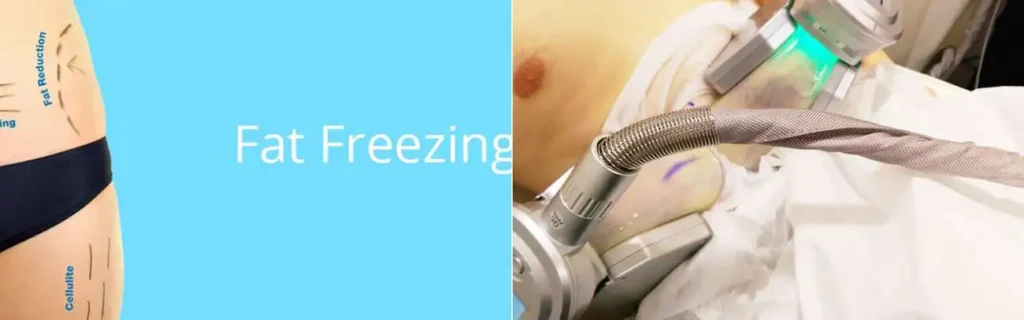 Fat freezing Worksop on multiple areas of the body