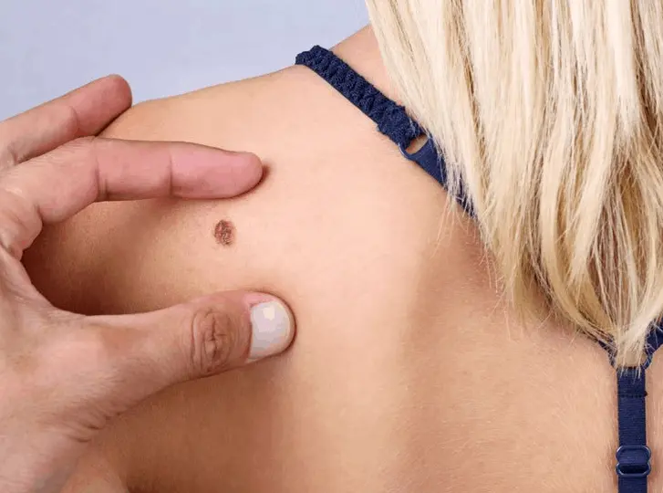 woman having mole removal Worksop consultation before treatment.