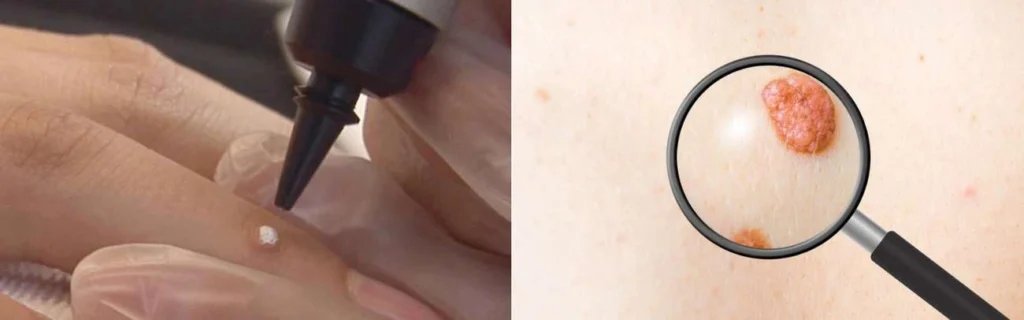 CryoPen practitioner Worksop assessing a benign mole before treatment
