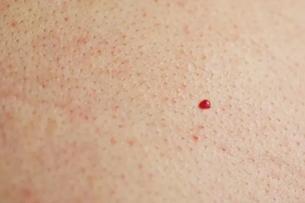 close up of a cherry angioma Worksop