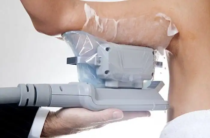 Picture of fat freezing Worksop on the upper arms.