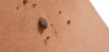 image of a skin tag Worksop