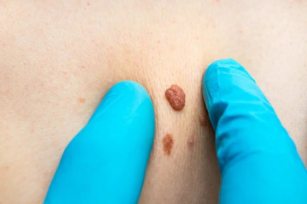 Consultant examining a skin tag Worksop