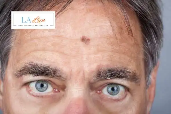 Solar Lentigo Removal Worksop image of man with mark on his forehead
