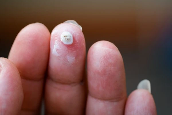 wart on person finger - cryotherapy to treat from LA LIPO Worksop