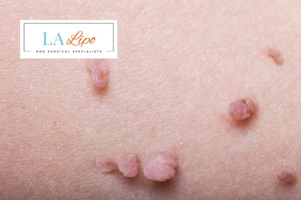 Does cryopen skin tag removal Worksop hurt? Find out now call our team today!