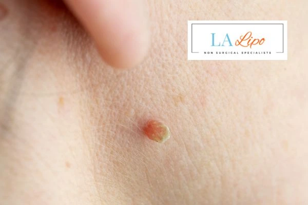 Book skin tag removal Worksop today speak to our team now!