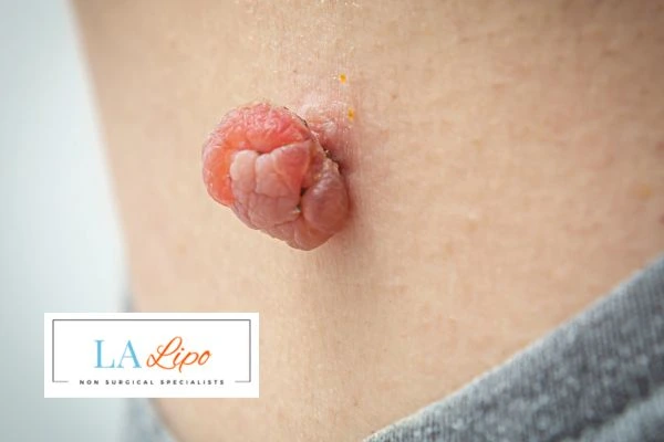 Interested in skin tag removal Worksop? Concerned about the pain? Find out more today!