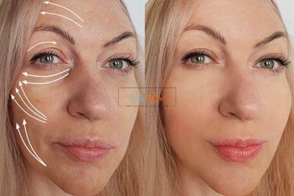 Morpheus 8 results Worksop face lift.