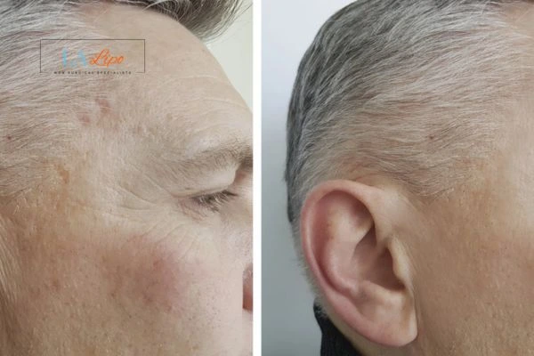 Mens Before & After Morpheus 8 Results Worksop
