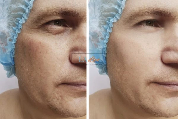 Before and after Morpheus 8 Results Worksop