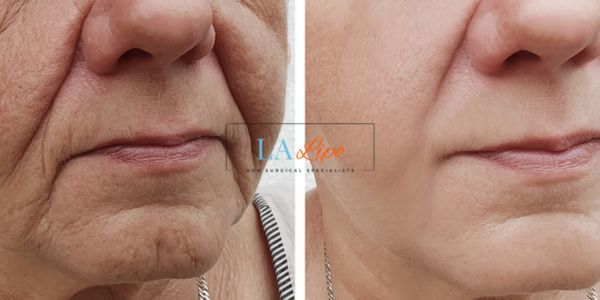 Older lady deeper wrinkle reduction - LA LIPO Morpheus 8 Results Worksop