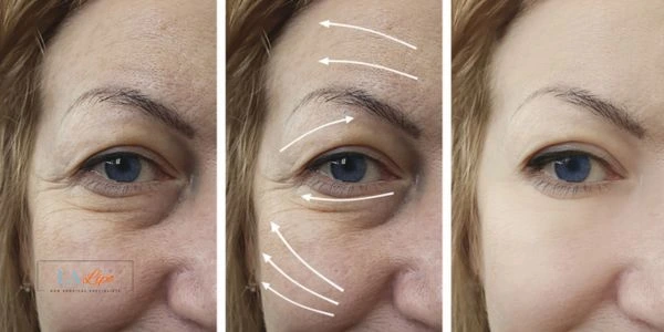 Amazing eye lift Morpheus 8 results Worksop