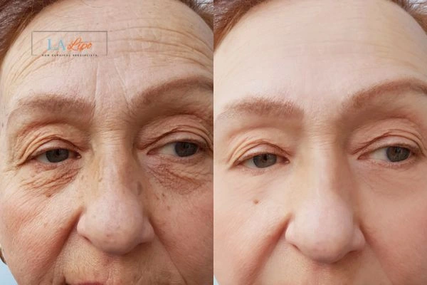 The powerful benefits of Morpheus8 Treatment Worksop - Call Our team today!