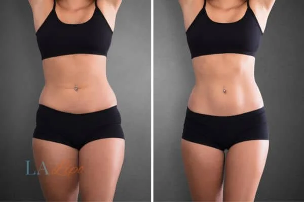 before and after results of non-surgical treatment to help a woman's body image and mental health Worksop