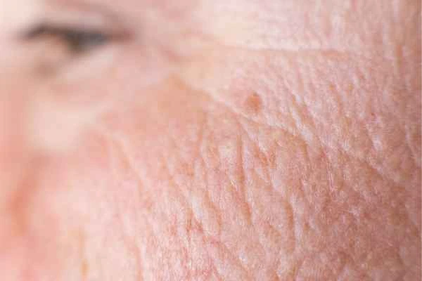 close up picture of a woman's face showing an age spot Worksop