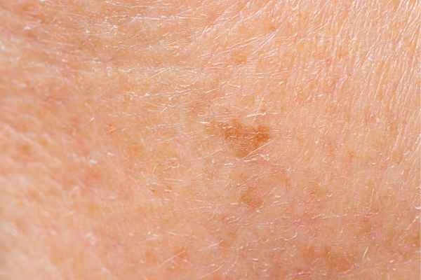 close up picture of age spots Worksop