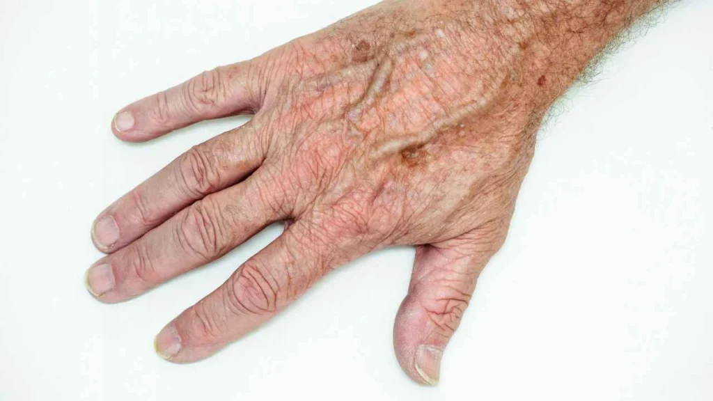 Male hand showing age spot Worksop