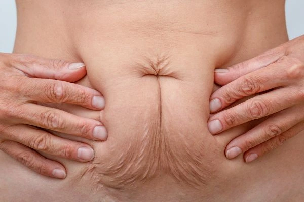 Image of a woman's stomach with loose skin - example of skin tightening Worksop options