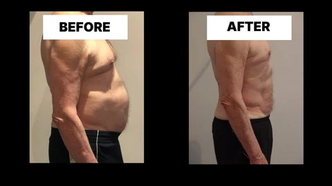 What Symptoms Can Diastasis Recti Cause in Men? Weak Core, Back Pain and Poor Posture Worksop